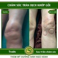 Chăm Sóc Tràn Dịch Khớp Gối - Ảnh 1