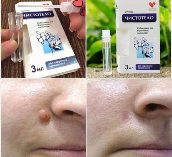 Gel tẩy tế bào chết, mụn thịt, mụn cơm, mụn cóc....
