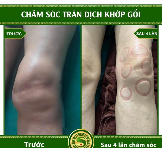 Chăm Sóc Tràn Dịch Khớp Gối