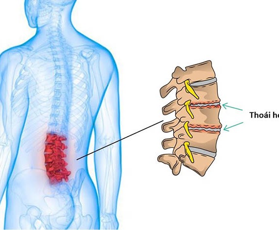 Thoái Hóa Đốt Sống Lưng